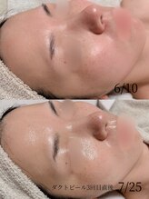 オンド(OND)/毛穴悩みの原因は、、、