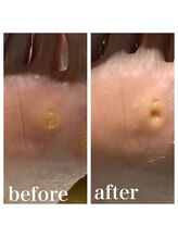 プラスキュア 用賀店(+CURE)/タコうおのめケア60分￥6600～