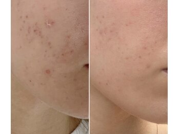 ヴィテラス バイ アリア(Veteras by aria)/☆光フェイシャル☆