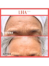 シフォン(Chiffon)/こじわやしみケアに！ララピール