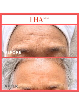 シフォン(Chiffon)/こじわやしみケアに!ララピール