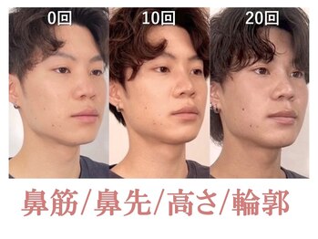 ラプリエイル 千葉店(Raplit aile)/ 隆鼻+輪郭矯正40分20回