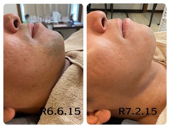 フィズ 五日市彩が丘店(FIS)/☆before/after☆五日市脱毛