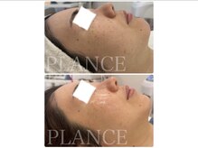 プランス 恵比寿店(PLANCE)/施術直後からツヤツヤ
