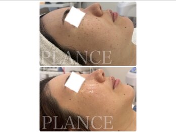 プランス 恵比寿店(PLANCE)/施術直後からツヤツヤ