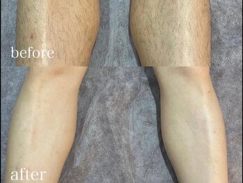 エリクサー 加須店(Elixir)/薄めの毛でもしっかりと照射!◎