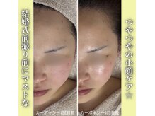 ハニエル(Haniel)/カーボキシー症例