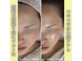 ハニエル(Haniel)/カーボキシー症例