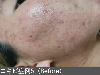 オアシスラグーン(OASIS LAGOON)/ニキビ改善(症例5 before)