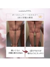 トータルサロン ヴィータ(VITA.)/ポールシェリー痩身/beforeafter