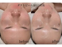 オンド(OND)/赤みがとれることで透明感up