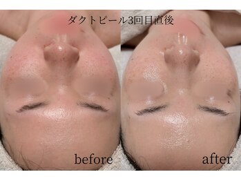 オンド(OND)/赤みがとれることで透明感up