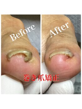 プラスキュア 用賀店(+CURE)/巻き爪矯正【1爪】+爪切¥8800