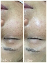 メイユール(MEILLEUR)/光フェイシャル