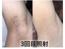 ヴィーヴ 京橋(vive)/レディース【脱毛】ワキ3回目