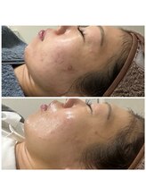 ミイン(美in)/美顔幹細胞