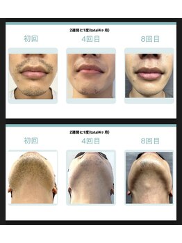 ペルレ(Perle)/ひげ　症例写真 2