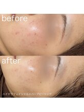 ルルラ リコ(lulula rico)/症例写真/ハーブピーリング