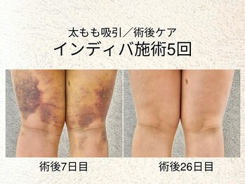 久留米スポーツ整骨院 整体院/ダウンタイム短縮/インディバ