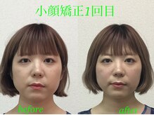 オズ六本木/圧倒的小顔＠小顔矯正オズ六本木