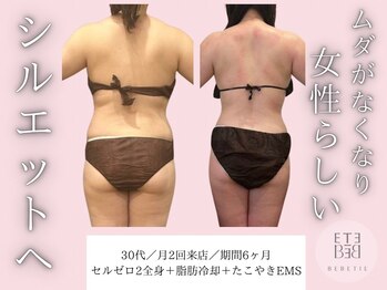 ベベティー(BEBETIE)/産後太りから数年経っても痩せる