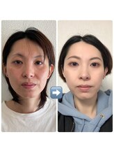 ナゴミ(NAGOMI)/全てのお悩み解消ゴールドコース