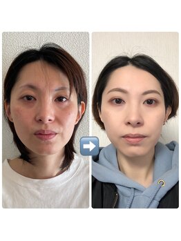 ナゴミ(NAGOMI)/全てのお悩み解消ゴールドコース