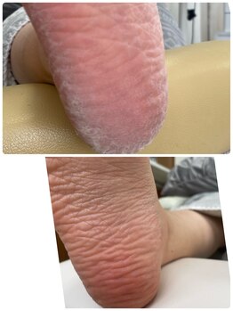 エクラプラス(Eclat.plus)/足裏全体ケア