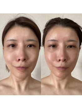 ララルアナ(Lara luana)/小顔×リフトUPケア◎ヘッドスパ