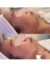 メゾン アンジュ(Maison Ange)/【小顔フェイシャルコース】