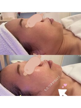 メゾン アンジュ(Maison Ange)/【小顔フェイシャルコース】