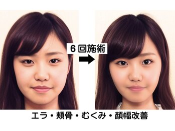 ニュートラル 渋谷店(NEUTRAL)/小顔矯正結果［小顔/骨盤］
