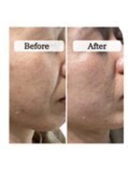 ル ボヌール 伊那店(le bonheur)/シミ改善コース経過