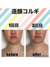 ルース(LUCE)/歪み・二重顎も改善！