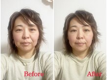 シルフィード/目の下のたるみスッキリ