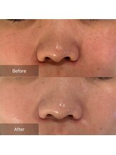 マインエム(mine.m)/毛穴・黒ずみ・ざらつき