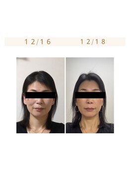 ミヤビ(miyabi)/小顔矯正