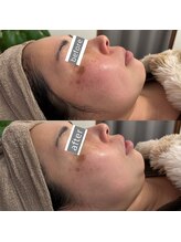 マハロ(mahalo)/ザラつき・毛穴引き締め