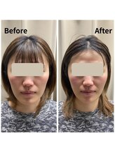 フェイエール鍼灸院 ラスィーヌ(fier鍼灸院 racine)/小顔矯正