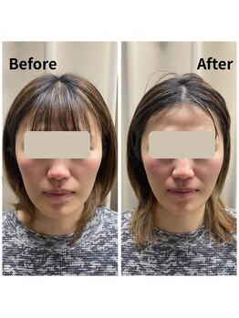 フェイエール鍼灸院 ラスィーヌ(fier鍼灸院 racine)/小顔矯正