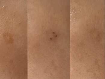 リシア(RECIA)/シミケア<施術前/施術後/6回目>