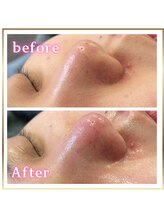 ピュアスキンサロン 恵比寿店(pure skin salon)/毛穴洗浄　ハイドラフェイシャル