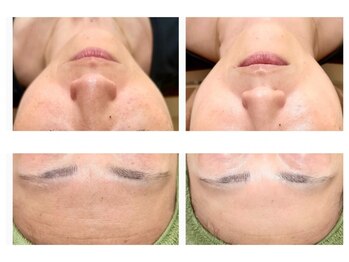 アイリス(iris)の写真/繰り返す肌荒れに★ダウンタイムなし◎肌に優しい艶肌メソッド♪何度も鏡を見たくなる素肌へ導きます♪