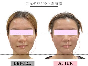 グレースエール トータルビューティーサロン(Grace Aile)/口元のゆがみ・左右差