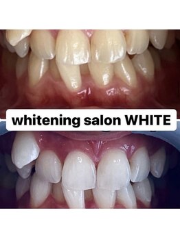 ホワイトニングサロン ホワイト(WHITE)/セルフホワイトニング☆効果