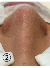 ビアンカーラ(Biancara)/【韓国式3D毛穴洗浄】途中経過