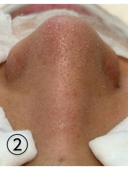 ビアンカーラ(Biancara)/【韓国式3D毛穴洗浄】途中経過