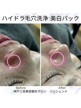 ハリシェンド/ハイドラ毛穴洗浄×美白パック