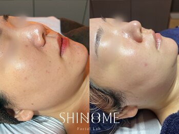 シノノメ(SHINONOME)/*美白 シミケア