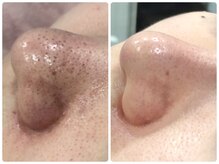 ベルネ(BELLUNE)/ベルネ式毛穴洗浄